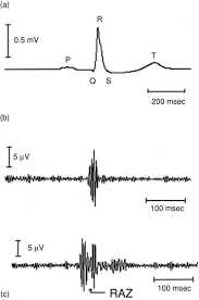 Image result for Electrocardiogram Validity