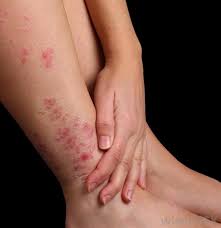 Minor trauma is another common cause of petechiae. What Is Petechial Rash With Pictures