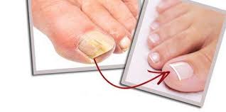 Tırnak makası sterilizasyonu, bıçaklarda veya sapta bulunabilecek zararlı bakterileri öldürdüğü için sağlıklı tırnakların korunmasının kritik bir parçasıdır. Tirnak Mantari Nedir Neden Olur Belirtileri Ve Tedavisi