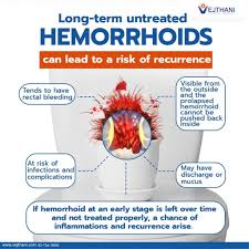 Image result for Hemorrhoid
