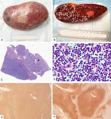 Image result for Splenomegaly