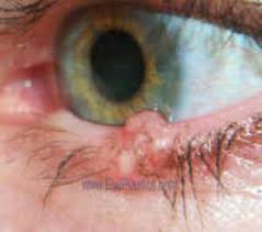 What starts as a pesky lash in your eye ends with you on the operating table, as dr. Basal Cell Carcinoma Bcc Eyelid Cancer