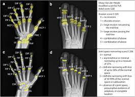 Rheumatoid arthritis can be difficult to diagnose because many conditions cause joint stiffness and inflammation and there's no definitive test for the condition. Radiographic Scoring Methods In Rheumatoid Arthritis And Psoriatic Arthritis Springerlink