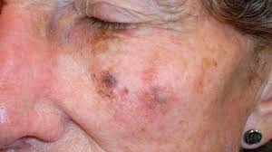 Lentigo simplex is the most common form of lentigo. Lentigo Maligna Melanoma Symptoms Pictures Treatment And More