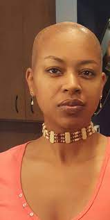 My Hair Journey With Scarring Alopecia Black Women Hair Loss Oil For Hair Loss Scarring Alopecia