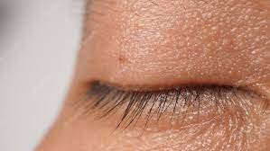 Premium Photo | Wart on face. macro shot of wart near eye. papilloma on  skin around eye nose and neck. close up of birthmark papilla or mole on  skin. small hard. benign