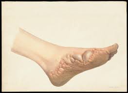 Image result for pompholyx soles of feet