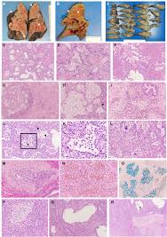 Normal term fetal liver, high power microscopic. Lung Transplantation For Patients With Severe Covid 19 Science Translational Medicine