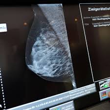 Erfahren sie hier mehr über die untersuchung beim arzt und die selbstuntersuchung der brust. Mammografie Screening Die Wichtigsten Fragen Und Antworten Gesundheit