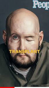 First Total EYE TRANSPLANT! Groundbreaking Surgery!