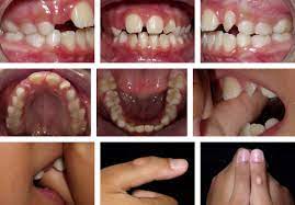 Behaviors like thumbsucking in childhood narrow the arch of the mouth which forces upper teeth to move forward. Breaking The Thumb Sucking Habit When Compliance Is Essential