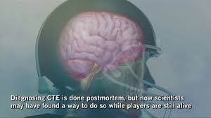(7 sep 2017) what is cte? Scientists May Have Found A Way To Diagnose Cte In Football Players While They Re Still Alive Los Angeles Times