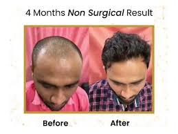 At la fue hair clinic we provide a natural looking and the best fue hair transplant and fue hair restoration services to clients who suffer from hair loss using the latest technique follicular unit extraction fue. Dr Stuti Khare Shukla India S Top Hair Doctor Transforming Lives Globally Times Of India
