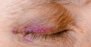 Bruising occurs when blood pools under the skin after an injury. Ecchymosis Definition Causes And Treatment