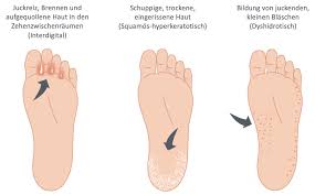 Fusspilz Erkennen 4 Bilder Der Symptome August 2021