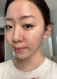 Acne and pigmentation solutions available