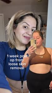 Hi all just wondering for those that have had a total abdominal  hysterectomy did you lose weight after surgery ? Was it straight away or  did it take a few weeks ?