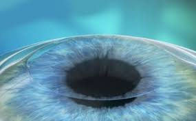 Kerusakan ini umumnya disebabkan tingginya tekanan dalam bola mata. Biaya Operasi Lasik Mata Malaysia Eye Center