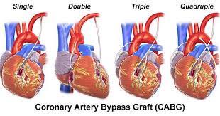 Imgur Com Bypass Surgery Coronary Arteries Arteries