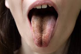 Image result for brown tongue symptoms