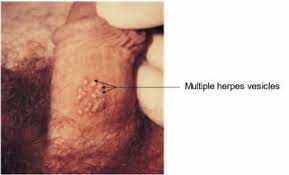 Bumps, spots, or other types of raised lesions could be the results of something as harmless as an ingrown hair or razor bumps, or it can be a serious viral infection like herpes or genital warts. How To Tell Genital Herpes Apart From Other Skin Conditions