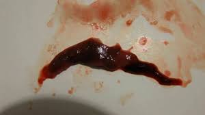 If you are pregnant or planning to become pregnant, tell your doctor before having the procedure. Miscarriage Blood Clot Pictures By Pregnancy Weeks Youtube