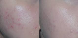 Vorher nachher bei unreinheiten & pickelmalen: Test Anti Pigment Serum Eucerin Anti Pigment Dual Serum Testbericht Von Hoglet