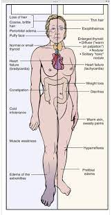 It can also result in problems with your hair, skin,. Hypothyroidism And Hyperthyroidism Etiologies Cause And Clinical Manifestations Symptoms Diagram Quizlet