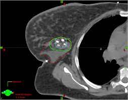 Learn the stage of your cancer. Breast Cancer Radiation Planning Imaging Technology News