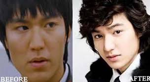Somtimes Surgery Works Out Well Bravo Celebrity Plastic Surgery Plastic Surgery Korean Plastic Surgery