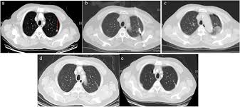 Nasopharyngeal cancer treatment options include radiation therapy, chemoradiation followed by adjuvant chemotherapy, surgery, and chemotherapy. Value Of Ablation Therapy In The Treatment Of Lung Metastases Qi 2018 Thoracic Cancer Wiley Online Library