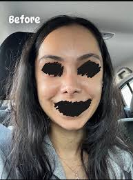 I went to Dr Yusuf Orhan Ucal for revision rhinoplasty in May 2024, I am 8  months PO. One of the worst descisions of my life. I had 2 open surgeries  before