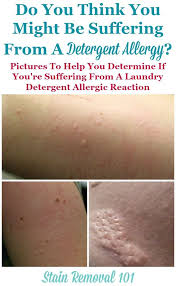 Detergent Allergy Pictures Find Out If You Re Allergic To Laundry Detergent Laundry Detergent Allergies Allergic Reaction Remedies
