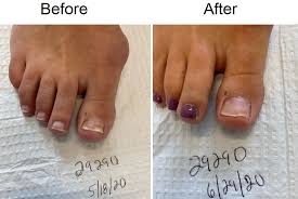 Toenail Fungus Before And After Photos Podiatrist In Manhasset Huntington Plainview Maspeth Great Neck Ny