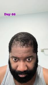 Day 66 : Started MesoTherapy today and we applied the hair serum and used  the dermatologist roller, we will repeat this process every 15 days  #brianhairlossjourney #reels #typ #foryou #foryoupage ...