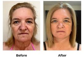 Before & after treatment. Further Elen Baron Amsterdam, Netherlands Belgium  Maria Kenig Marie-Chantal Weber Míkonos Utrecht, Netherlands Konstantinos  Panagopoulos Malta Ekáli, Greece Learn Italian with Ines #italy #milano  #rome #Lambardia Pisa, Italy #