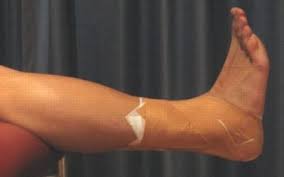 Image result for Taping for Soleus and Achilles