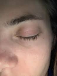Image result for milium cyst on eyelid