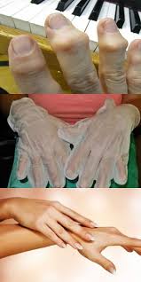 как избавиться от пигментных пятен на руках народными средствами Kostochki Na Sustavah Zrelishe Ne Iz Priyatnyh Kurs 10 Procedur Takim Obrazom Mozhno Izbavitsya I Ot Kostochek Na Nogah Zdorove Produkty Dlya Zdorovya Zdorove Ot Prirody