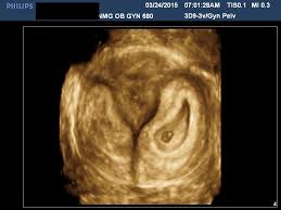 Wanita yang mempunyai kitaran haid yang kurang teratur mungkin dengan mengetahui tanda ovulasi sedang terjadi adalah lebih mudah untuk anda mencuba. Embryo Implantasi 25 Gambar Tanda Tanda Implantasi Dalam Uterus Ovum Gejala Penyisipan Lewat Dan Awal Suhu Basal Dan Sensasi