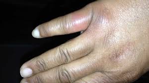 A spider bite, also known as arachnidism, is an injury resulting from the bite of a spider. I Have Bites But No Signs Of Bugs What S The Cause