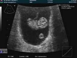 Check spelling or type a new query. Embarazo De 9 Semanas Youtube