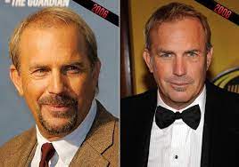 No matter the time of the hair transplant, his hair is noticeably different from back in 2006 to today. Did Kevin Costner Have A Hair Transplant Hair Transplant Hair Replacement Hair Transplant Before And After