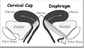 Image result for Cervical Cap