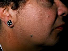 Polycystic ovary syndrome is the most common cause of hirsutism and it is due to associated hormonal imbalances that cause the ovaries to overproduce androgens. Excessive Hair Dermnet Nz