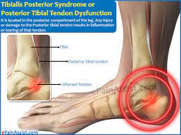 Tibialis Posterior Syndrome Or Posterior Tibial Tendon Dysfunction