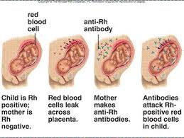 Image result for Rh Sensitization
