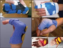 Image result for Radial Gutter Cast