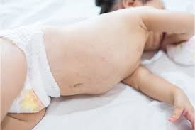 Image result for sweat rash on back baby
