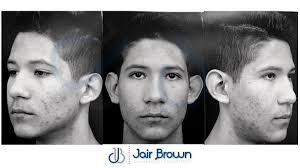 Resultados…👌🏾 Otoplastía en paciente masculino, el cual buscaba mejorar  lo prominente de sus orejas, procedimiento ambulatorio, resultado  inmediato, satisfacción de 100% (según un nuestro paciente), seguirá las  recomendaciones post operatorias para que